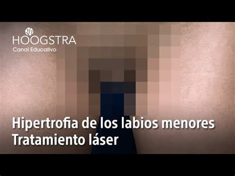 Hipertrofia de labios menores: ¿labios vaginales。